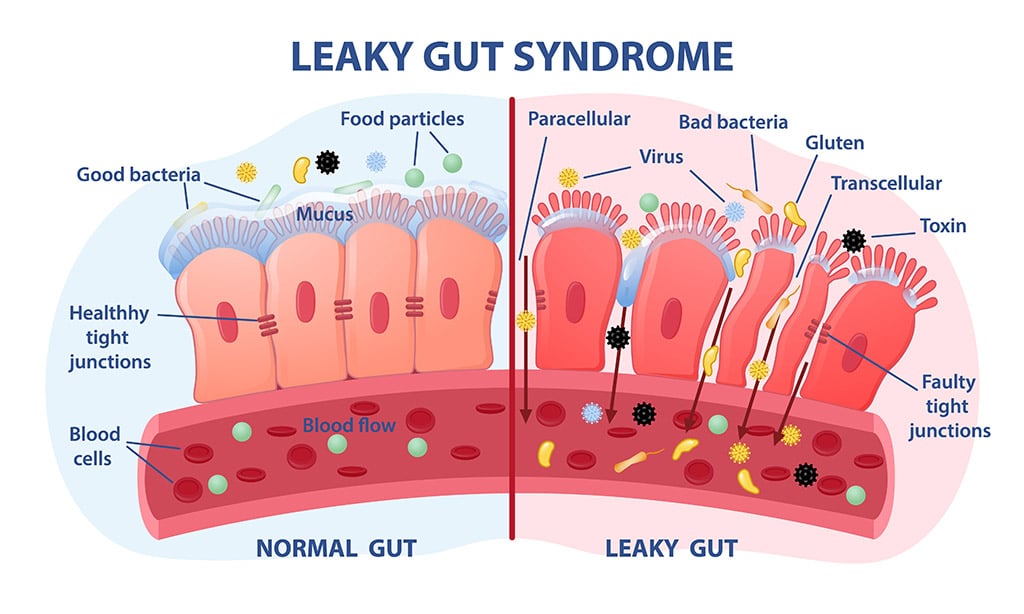 Neuro-energetic Kinesiology 4 leaky gut syndrom