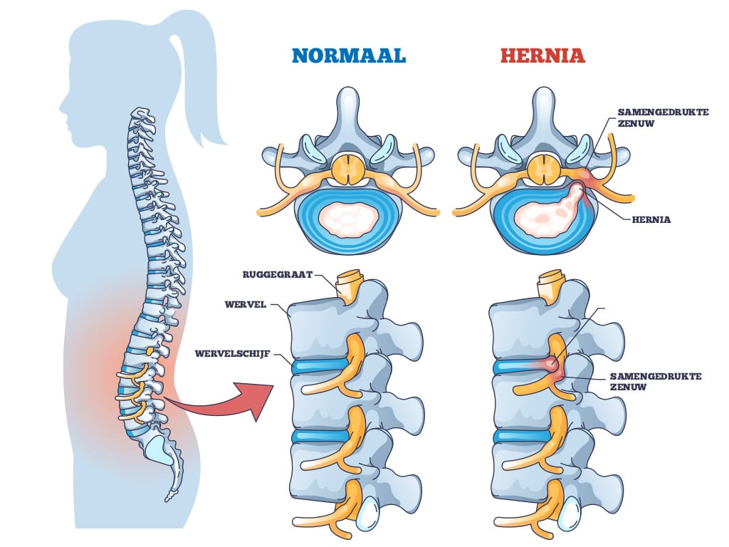 Hoe behandel je een hernia zonder operatie 2 hernia