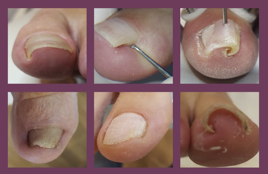 Ingroeiende teennagels reconstructie 1 ingroeiende teennagels 2